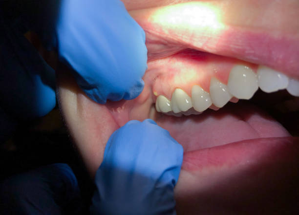 Best Dental Abscess Treatment in Tatum, TX